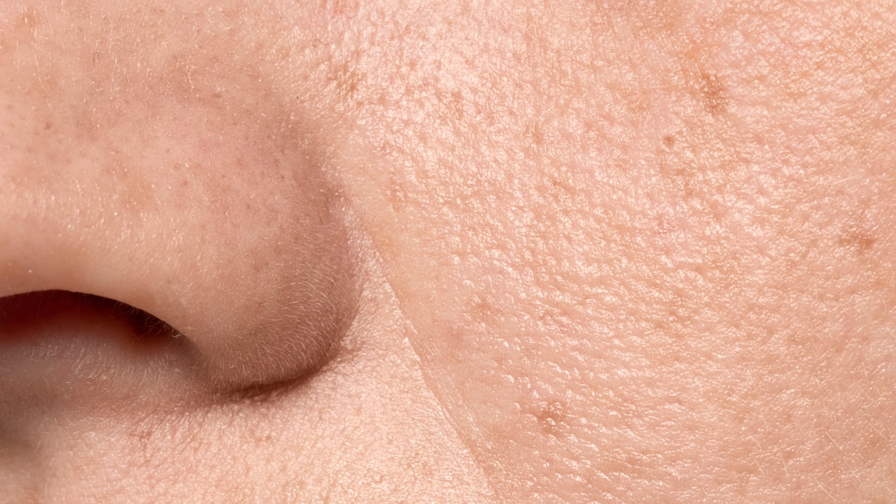 Overproduction of Oil (Sebum)
