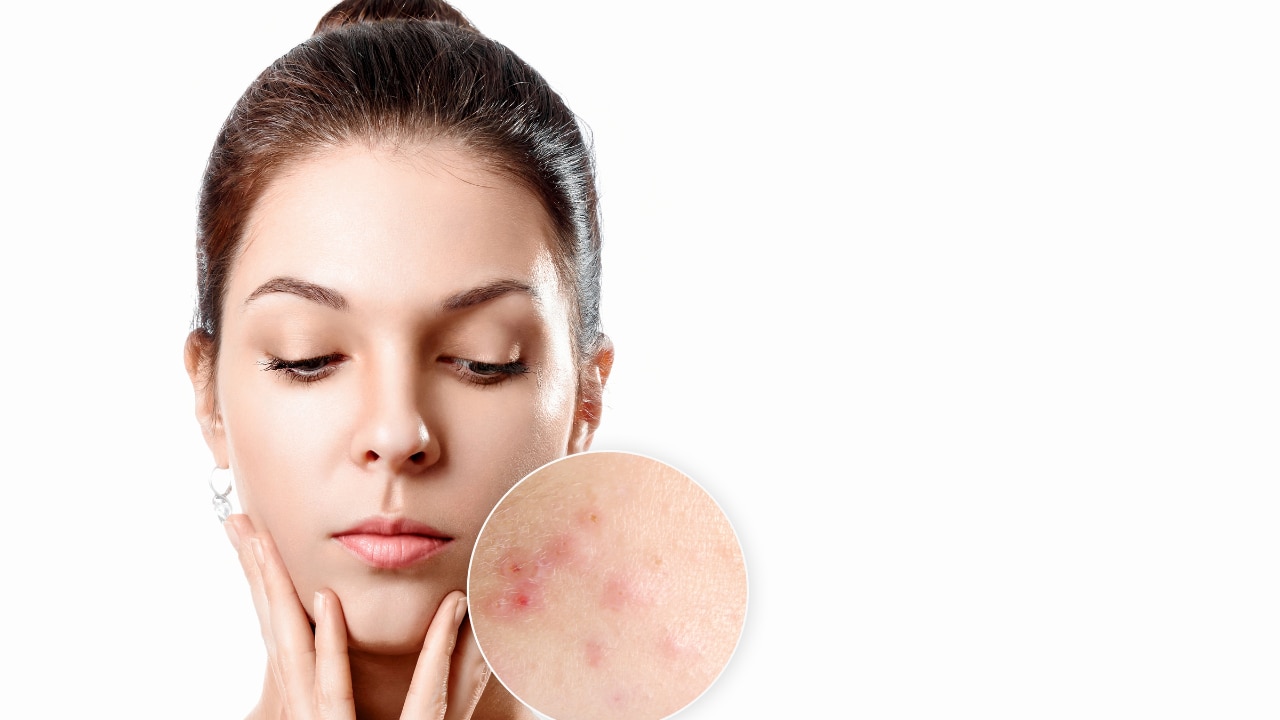 Prevents acne