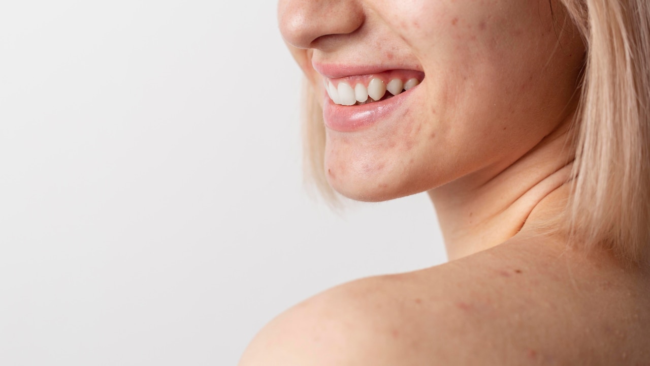 What Are Whiteheads?