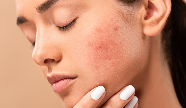 Skin Inflammation