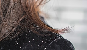 Dandruff giving you sleepless nights? These 5 tips will help 