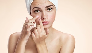 8 Effective Remedies To Reduce Heat Pimples Naturally