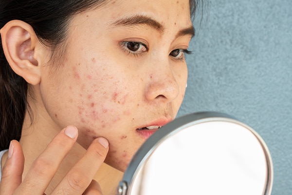 FAQs about light therapy for acne