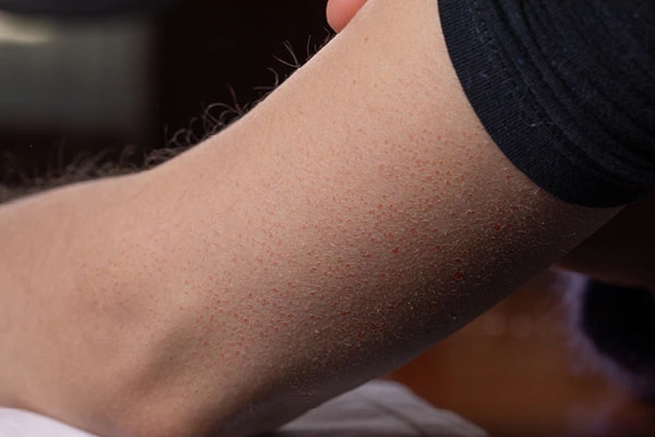 FAQs about keratosis pilaris 