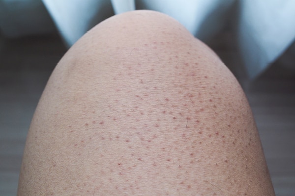 FAQs about keratosis pilaris 