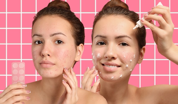 What's the difference between an acne patch and a spot treatment?