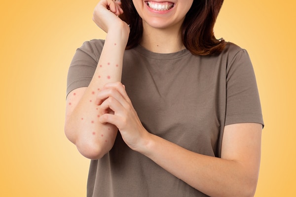 FAQs about scabies FAQs about scabies