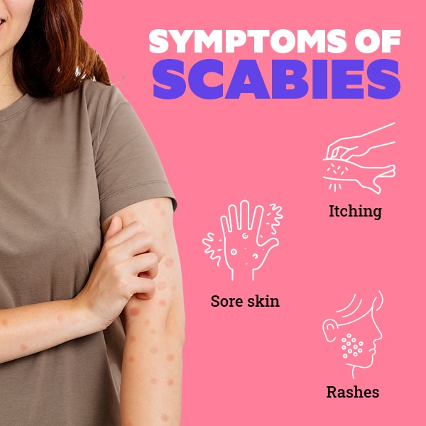 FAQs about scabies FAQs about scabies