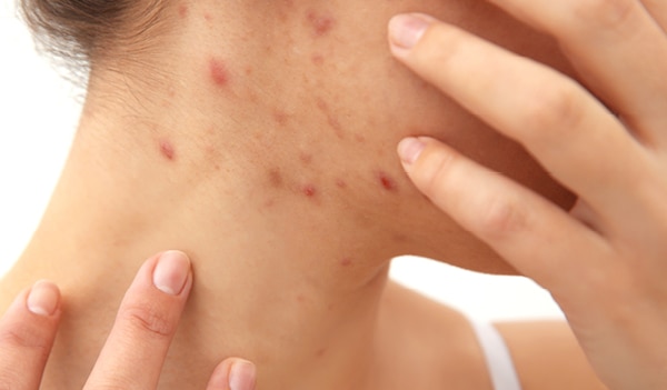An expert’s guide on the causes, prevention and treatment for scabies 
