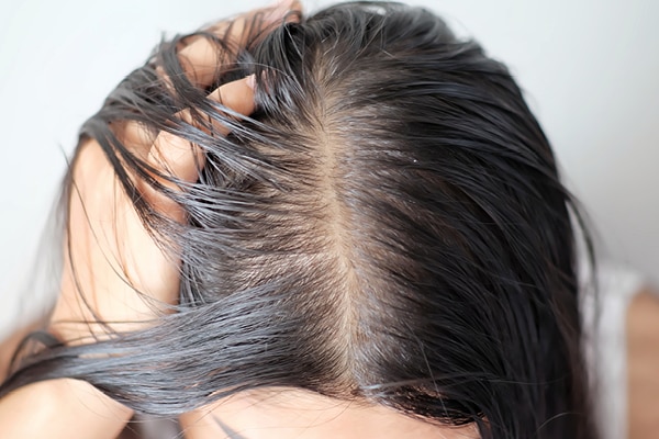 FAQs about ayurvedic treatments for dandruff