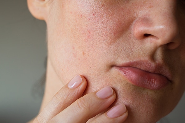 Use probiotic skincare to prevent acne