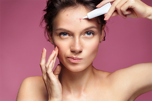 Use probiotic skincare to prevent acne