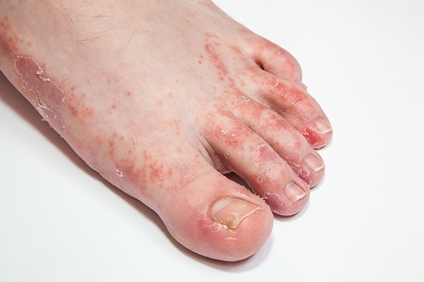 FAQs about tea tree oil uses for skin and hair FAQs about tea tree oil uses for skin and hair