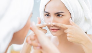 The Best Solution to Prevent and Remove Blackheads: Top 5 Tips 