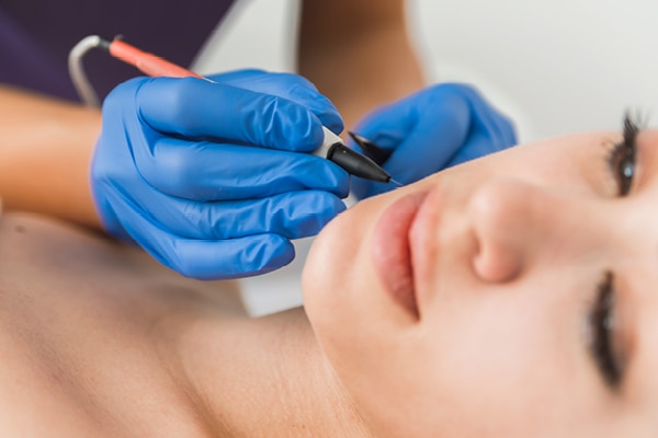 FAQs about electrolysis hair removal