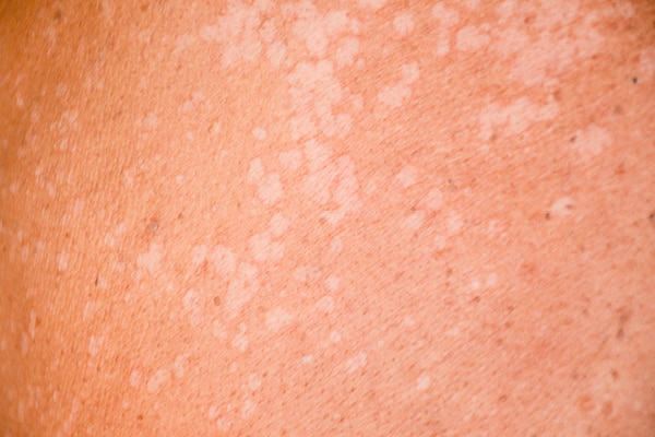 Preventing Pityriasis Versicolor