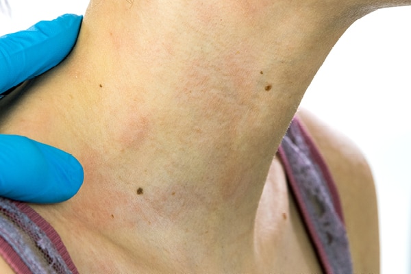 Preventing Pityriasis Versicolor