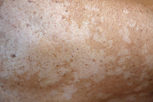 Preventing Pityriasis Versicolor