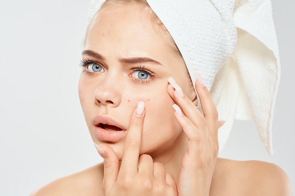 FAQs about doxycycline for acne