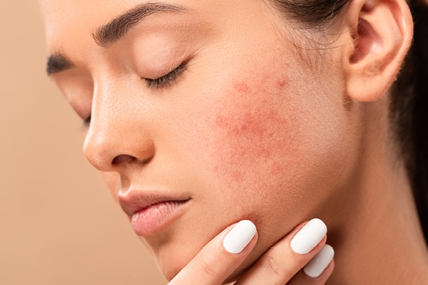 FAQs about doxycycline for acne