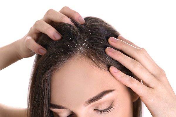 BB: Any home remedies that can help keep dandruff at bay this winter?