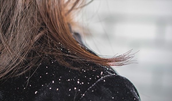 Follow these expert tips to have a dandruff-free winter