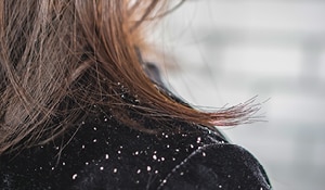 Follow these expert tips to have a dandruff-free winter