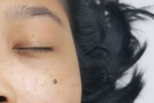 What are facial warts and how to remove them according to an expert