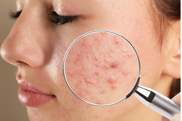 How to Know If Eggs Are Causing Acne on Your Face?