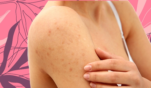 How to get rid of acne on your arms 