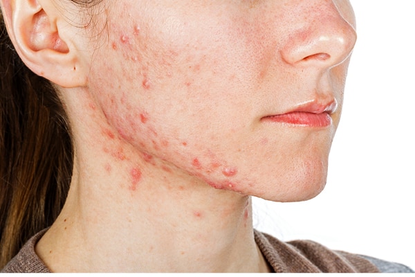 Dermat-Approved Treatments for Cystic Acne