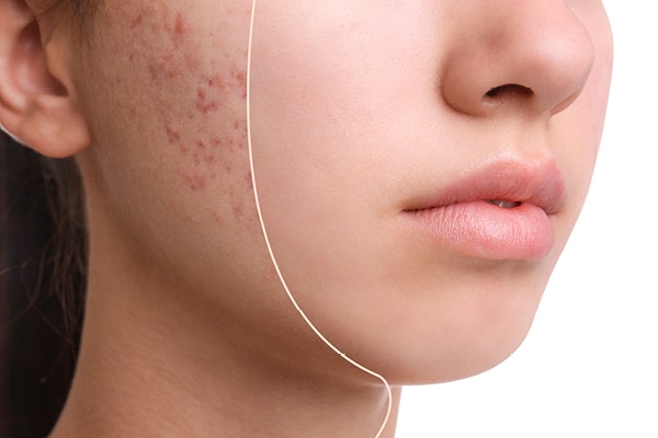 Dermat-Approved Treatments for Cystic Acne