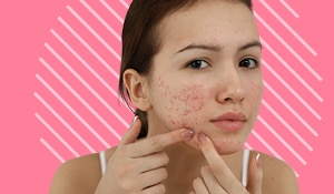 No more acne troubles! Best home remedies for cystic acne