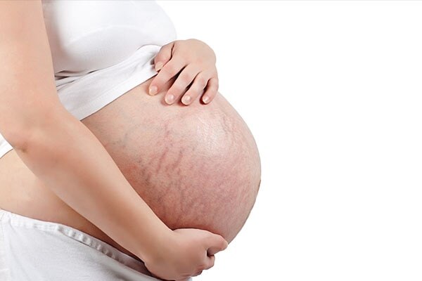 Stretchmarks2 Stretchmarks2
