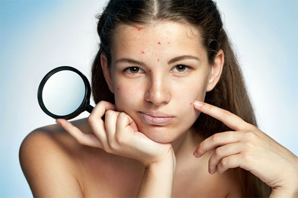 adult acne causes treatments adult acne causes treatments