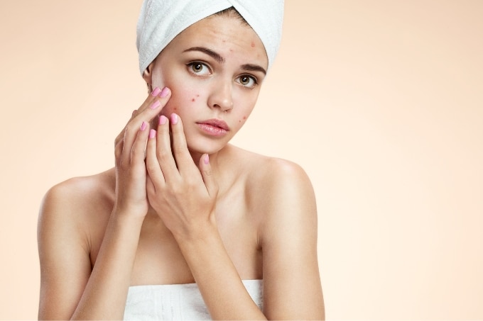 FAQs about Pimple Removal