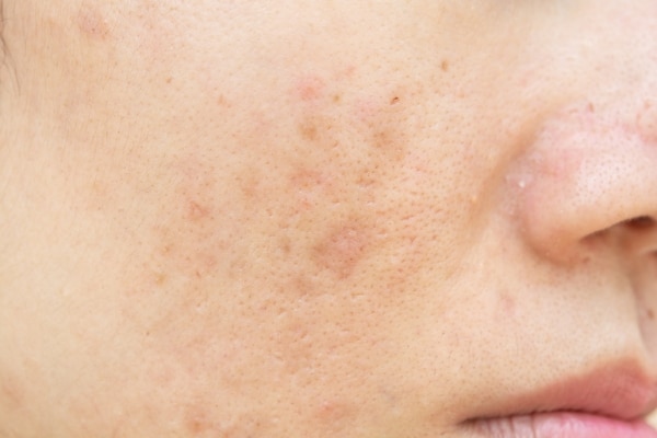 black-spot-battle black-spot-battle