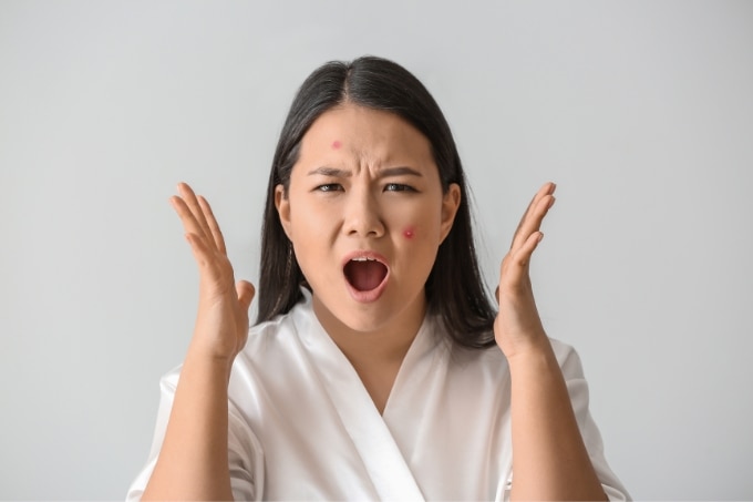 acne faqs acne faqs