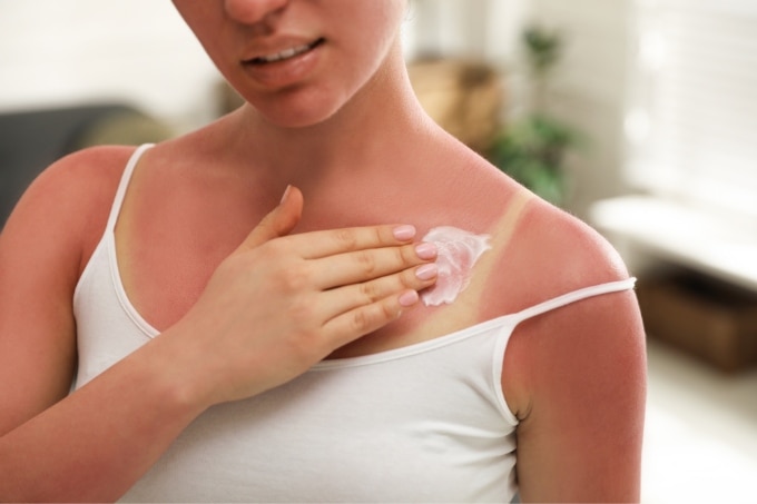 How to Treat Sunburn