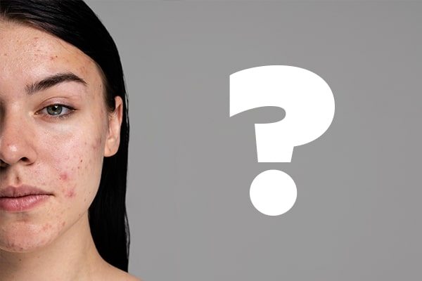 FAQs about Acne Prone Skin