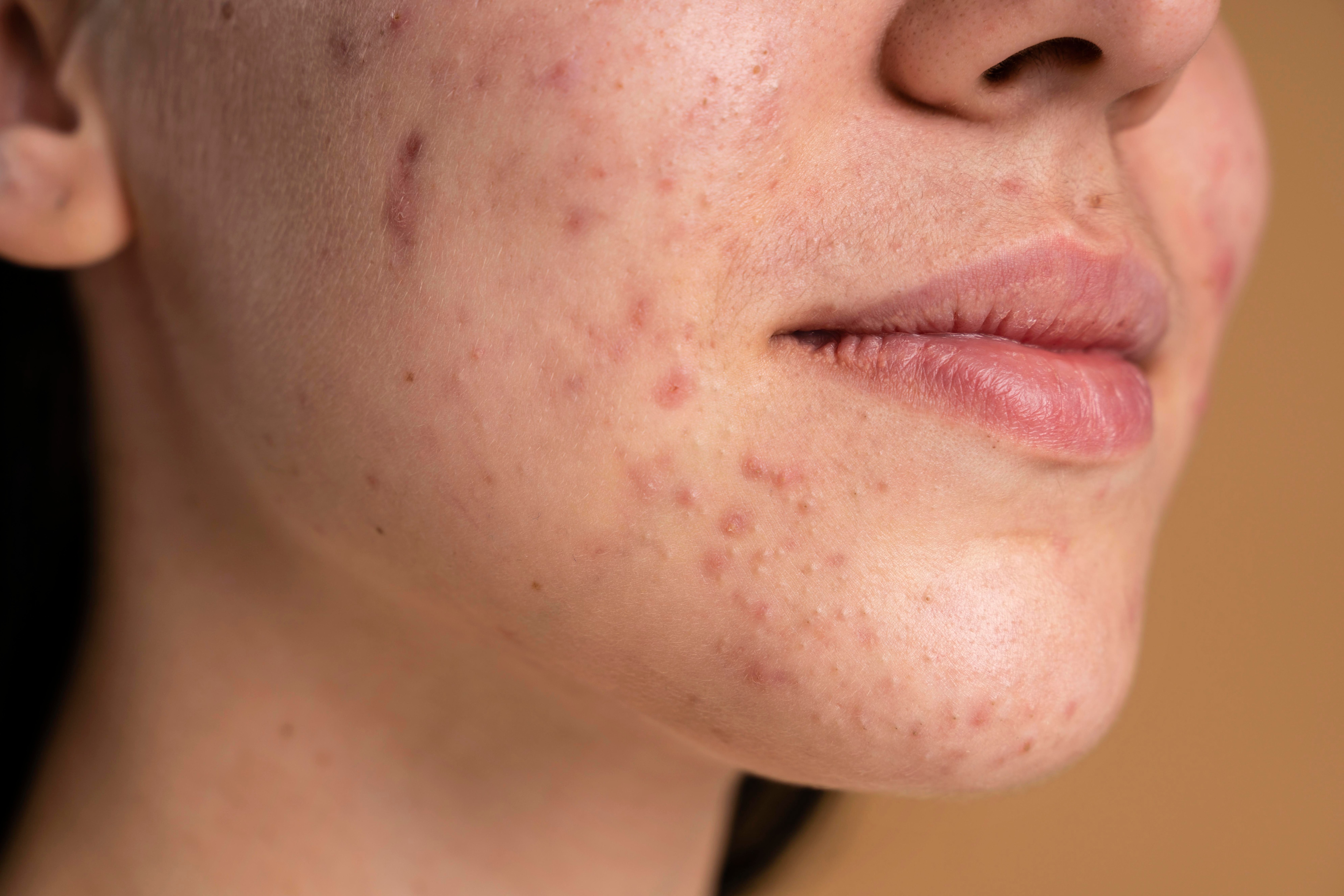 FAQs about Acne Prone Skin