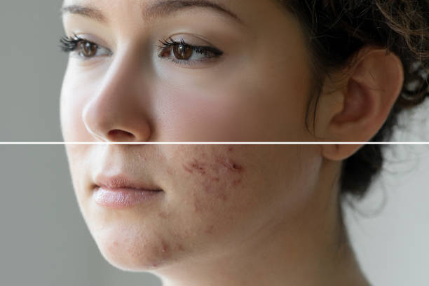 remove-pimples-naturally remove-pimples-naturally