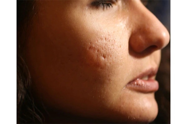 how to remove acne scars Simple Kind To Skin Soothing Facial Toner