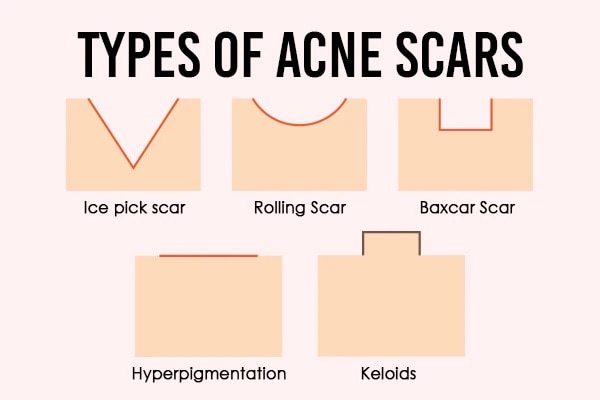 how to remove acne scars Simple Kind To Skin Soothing Facial Toner