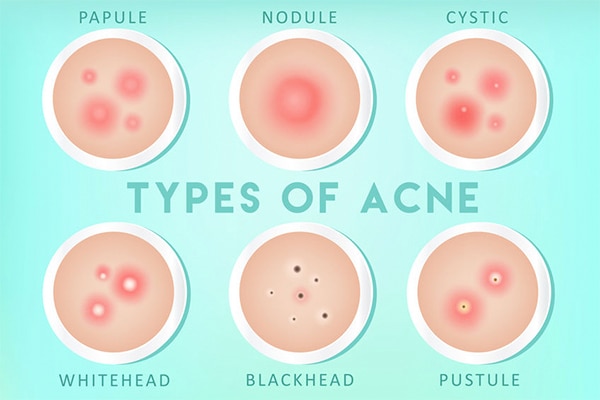 In-office treatments to get rid of acne