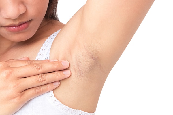 ingredients to get rid of dark underarms