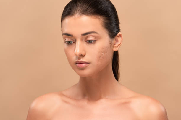 Get Rid of Acne Scars: Here’s How