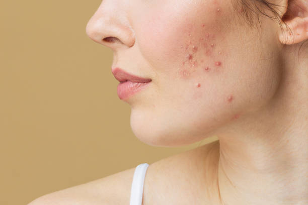 FAQs about Pimple Removal