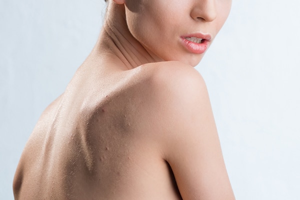skin expert dr rashmi shetty answers acne queries skin expert dr rashmi shetty answers acne queries